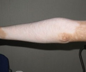 手臂白癜风发病的原因有哪些呢